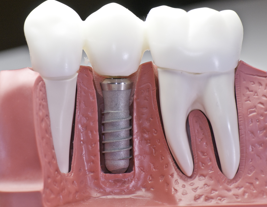 model of natural teeth in gums next to dental implant Baton Rouge, LA